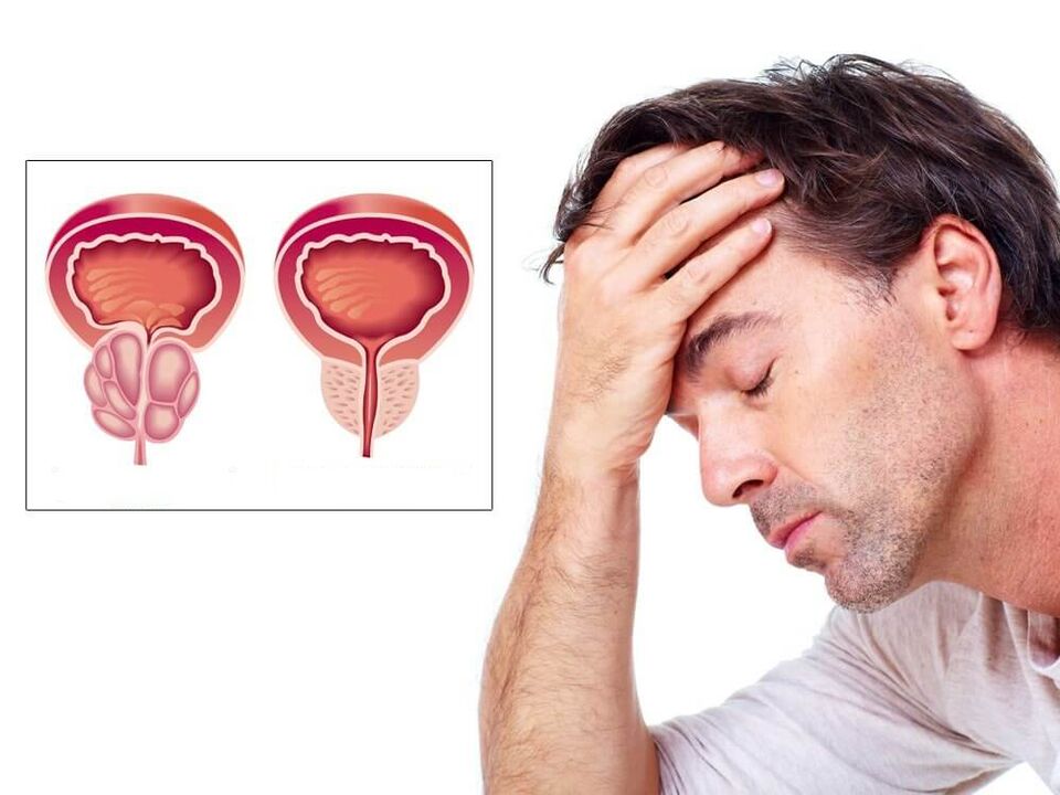 sintomas de prostatitis en hombres