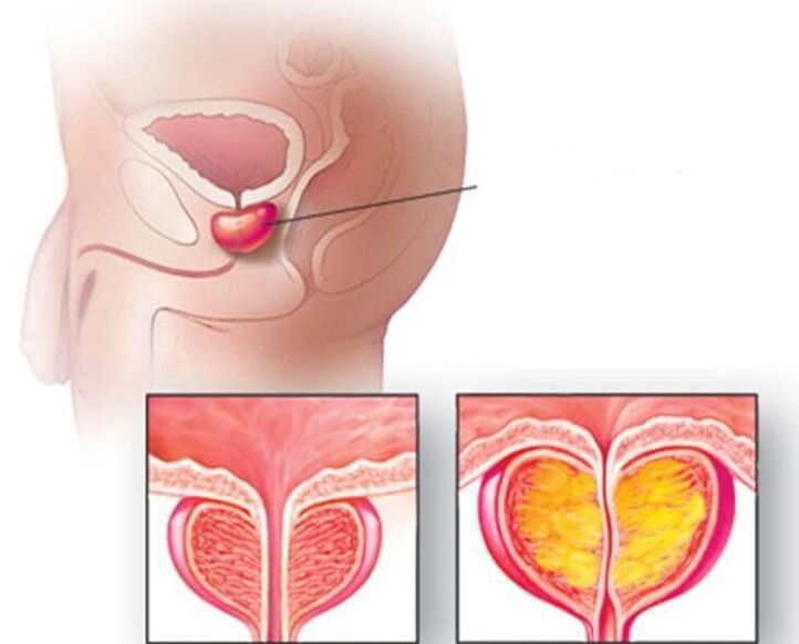 Ubicación de la glándula prostática, próstata normal y agrandada en prostatitis crónica. 