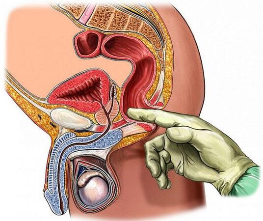 Diagnóstico de prostatitis