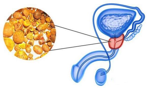 Problemas con la prostatitis
