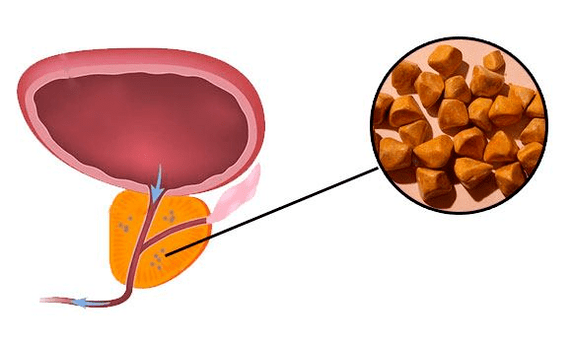 Los cálculos renales son una contraindicación para el tratamiento de la prostatitis con dispositivos.