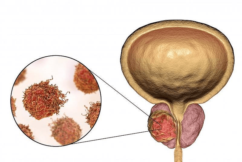 ¿Cómo se ve el daño a la próstata