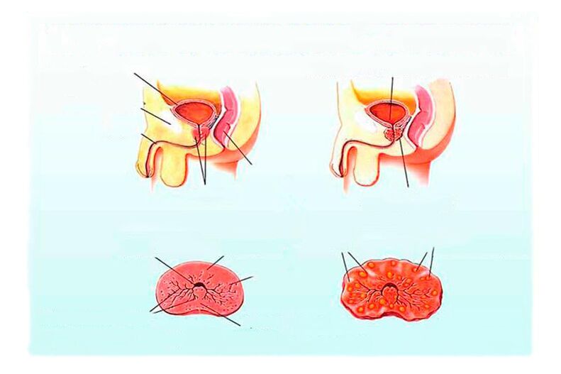 Signos de prostatitis crónica