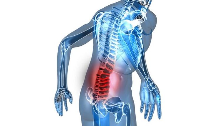 Inflamación con prostatitis congestiva.
