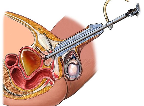 Tratamiento de la prostatitis