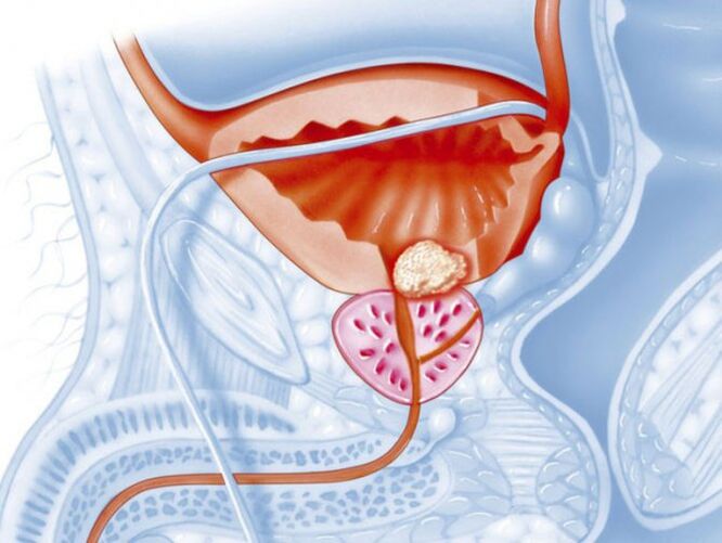prostatitis bacteriana