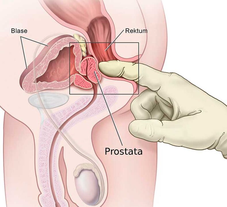 masaje prostático para la prostatitis