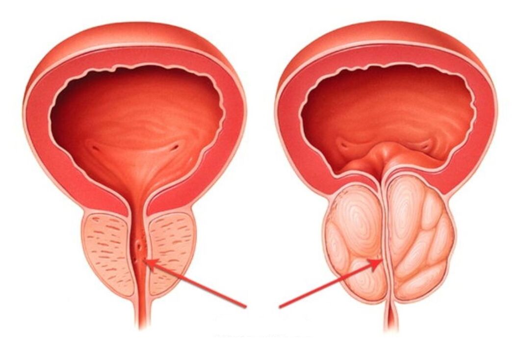 próstata sana e inflamada con prostatitis